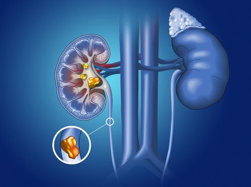 calculo-renal-1